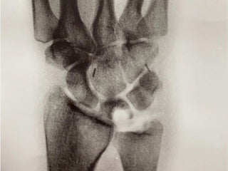 An x ray of professional rock climber and photographer Savannah Cummins broken bone.